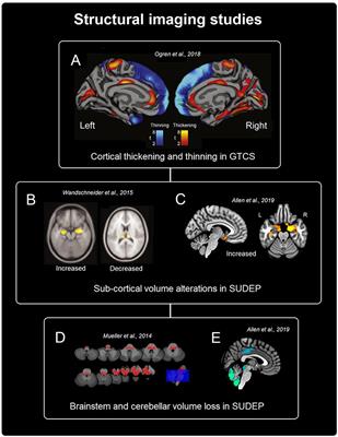 Neuroimaging of Sudden Unexpected Death in Epilepsy (SUDEP): Insights From Structural and Resting-State Functional MRI Studies